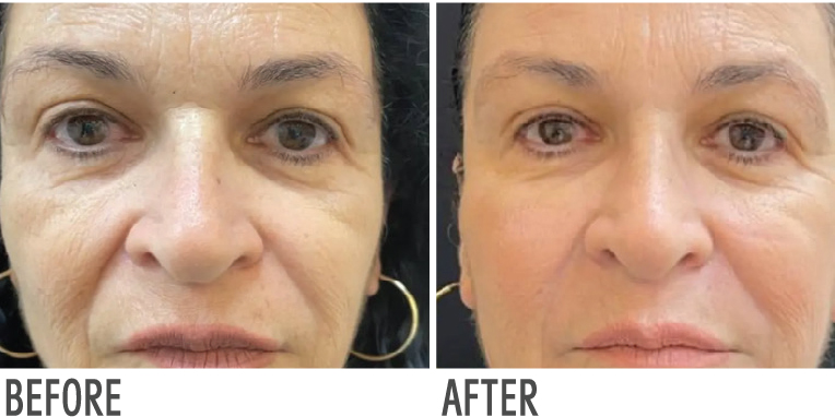 דוגמת תוצאה · Alma Skin Revolution